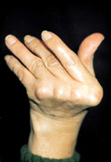 Artritis reumatoide: mano de una paciente