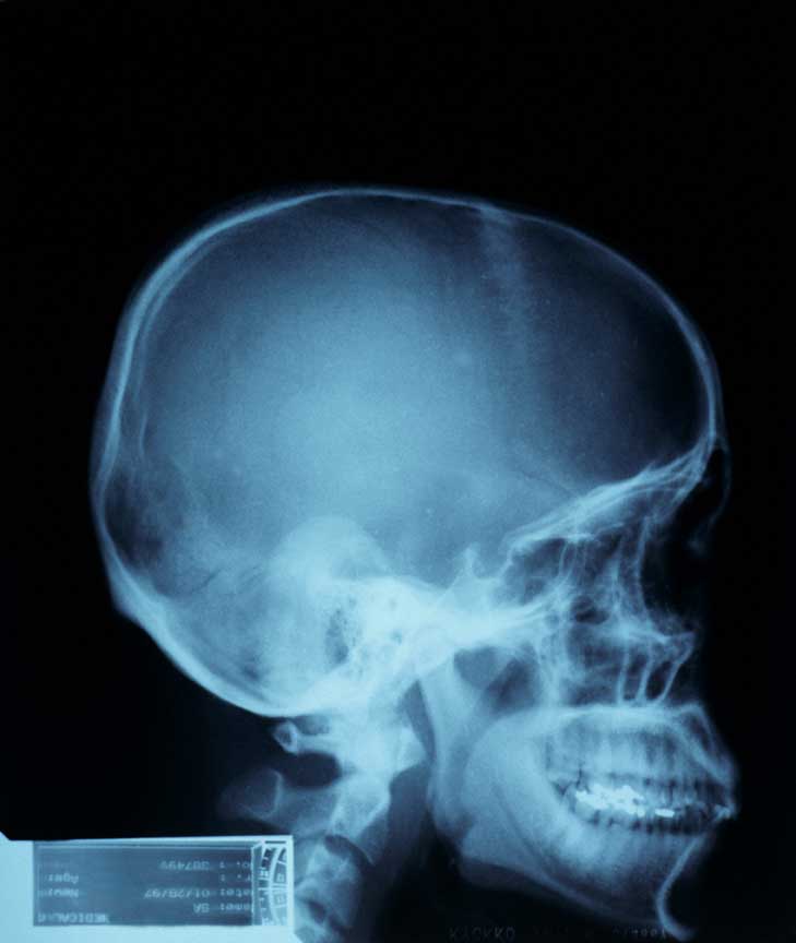 Radiografía de un craneo