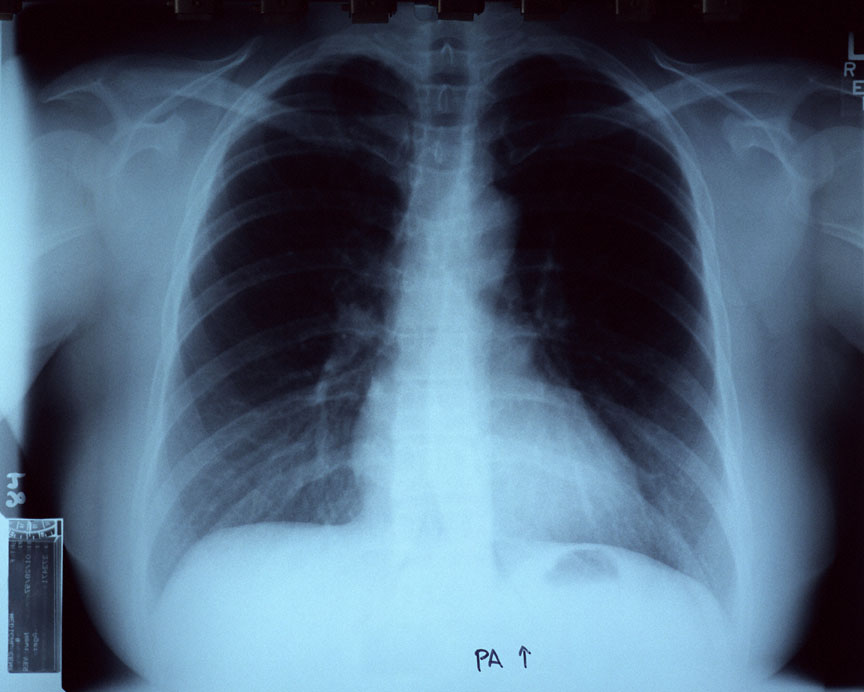 Radiografía de tórax (68 Kb)